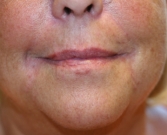 Feel Beautiful - Smile Lines Treatment (filler) - After Photo